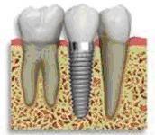 implantes dentales